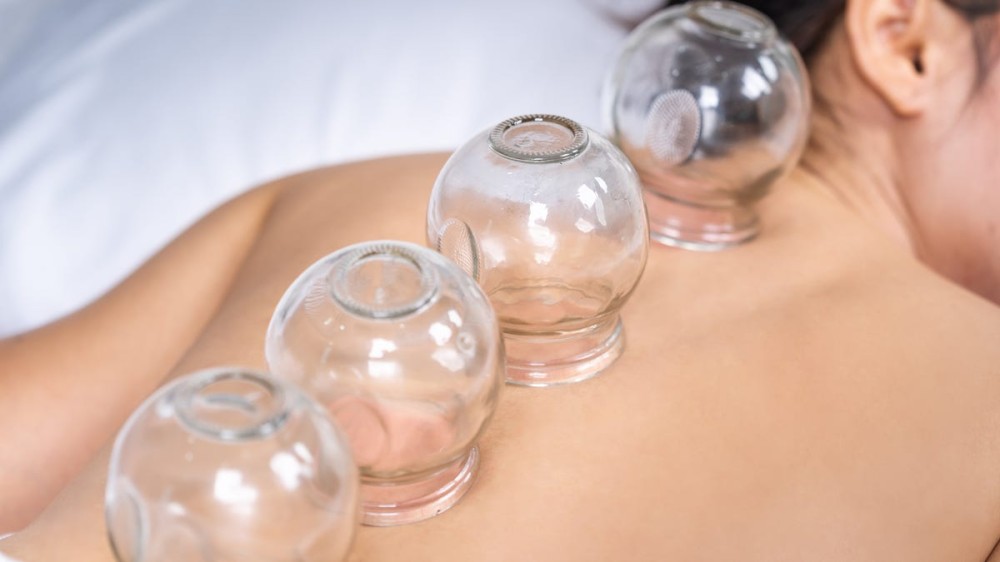 young woman receiving cupping treatment on back